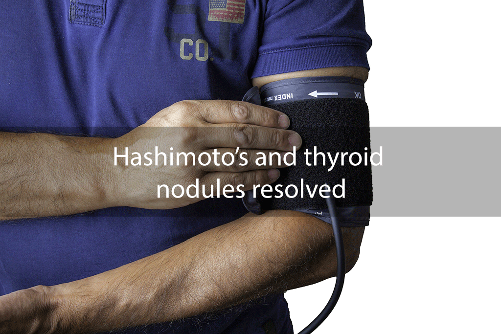 Hashimoto’s and thyroid nodules resolved